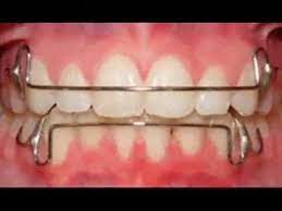 Retainers After Braces Types Of Retainers After Braces Types Of Braces After Braces Retainers