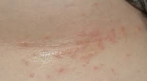 Image result for heat rash under breasts