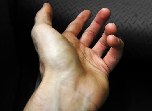Nổi gân xanh ở lòng bàn tay - Chớ chủ quan! | Medlatec