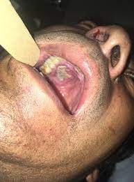 Mucormicosis criptocosis aspergilosis histoplasmosis otras. Mucormicosis Ulcera Necrotica Paladar Ocronos Editorial Cientifico Tecnica