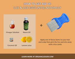 How To Get Rid Of Head Lice And Eggs With Natural Home Remedies Lice Eggs Head Louse Louse