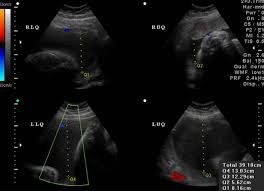 Ultrasound Assessment Of Amniotic Fluid Volume