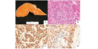 A drop in appetite often accompanied by a loss in weight are symptoms of breast cancer affecting the liver. Acute Liver Failure Associated With Diffuse Liver Infiltration By Metastatic Breast Carcinoma A Case Report