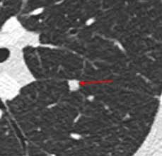 Image result for Nodule