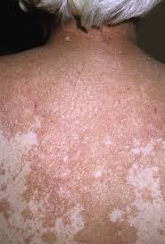 Maybe you would like to learn more about one of these? Pityriasis Rubra Pilaris Plastic Surgery Key