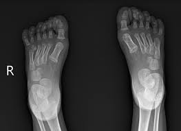 Image result for Supernumerary Digit