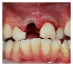 Image result for Tooth Avulsion