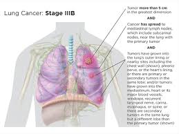 lung cancer staging lungevity foundation