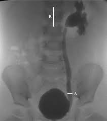 The exact cause of the damage is not always clear. Validation Of The Ureteral Diameter Ratio For Predicting Early Spontaneous Resolution Of Primary Vesicoureteral Reflux Journal Of Pediatric Urology