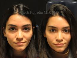 Botox & Restylane