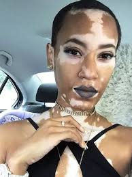 Menderita Vitiligo, Amy Deanna Berhasil Jadi Model yang Mendunia