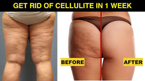 Free shipping over $40 · 10% off for first order · use code beauty10 How To Get Rid Of Cellulite On Thighs And Bum Fast At Home Just 1 Week 100 Naturally Youtube