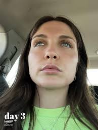 My Lip Filler Transformation Journey: Before & After 💋