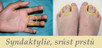 Cystická fibróza je autozomálne recesívne dedičné ochorenie, ktoré vzniká mutáciou génu pre cftr na dlhom ramienku 7. Syndaktylie Srust Prstu Pricina Informace Priznaky Projevy Obrazek Fotografie Lecba Pricina Diagnostika Priznaky A Projevy Nemoci