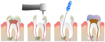 Signs you need a filling with more minor symptoms, you may only need a simple dental filling. Root Canal Treatment Wikipedia