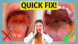 Image result for Strep throat infection roof of mouth