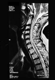 Tests that can indicate a diagnosis of. Spinal Cord Tumor Versus Transverse Myelitis The Spine Journal