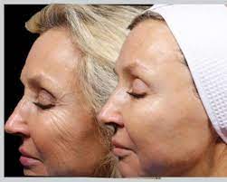 Check spelling or type a new query. Hifu 3d Und 5d Behandlung In Wien Forever Beautiful Cosmetics