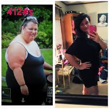 Gastric Bypass Results In 11 Months 200lbs Lost Roux En Y