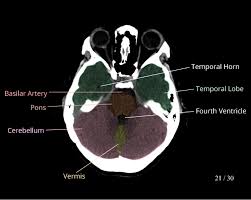 Image result for CT Head
