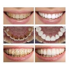 As a dentist, i'll give you some tips on how to reduce staining, as well as some options for whitening your teeth every now and then. How To Remove Coffee And Cigarette Stains From Teeth