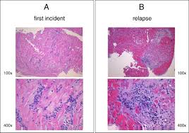 Recently, experts have proposed a the disease process in myocarditis can only be diagnosed by histological investigation of very. Recurrent Lymphocytic Myocarditis In A Young Male With Ulcerative Colitis European Journal Of Medical Research Full Text