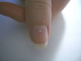 Finally An Answer To What The White Dots On Your Nails Mean White Spots On Nails Nail Health White Dots On Nails