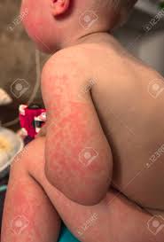 14.11.2018 · a food allergy occurs when your immune system thinks your food is an invader. Allergies Pimples On The Baby S Skin Food Allergy Skin Diseases Symptoms Stock Photo Picture And Royalty Free Image Image 132264751
