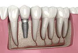 We did not find results for: Dental Implant Wikipedia