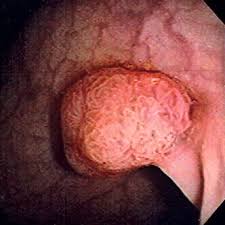 Image result for Colonic Polyp