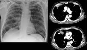 Occupational asbestos exposure is associated with several benign lung and pleural diseases, particularly asbestosis, pleural plaques, visceral . View Image