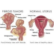 Fibroids Miracle Official Website Heal Uterine Fibroids Naturally Fibroid Tumors Fibroids Treatment Fibroid Uterus