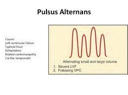 Pulsus Alternans Google Search