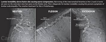 Failed Back Surgery Syndrome Treatment Options Caring Medical Florida