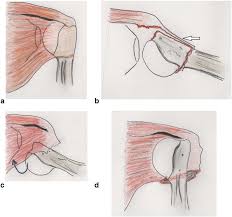 Start studying basic shoulder anatomy. Axillary Artery Injury After An Anterior Shoulder Fracture Dislocation And Periosteal Sleeve Avulsion Of The Rotator Cuff Sarc Case Report And Review Of The Literature Abstract Europe Pmc