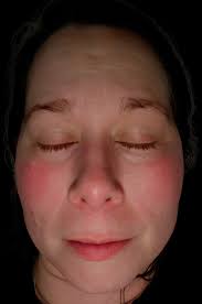 Does anyone else get little lumps like this from tigging? It's been