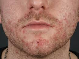 Image result for folliculitis symptoms