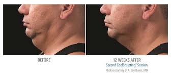 It will take about 2 weeks to a month to see results, but keep at it and you'll love how. Reduce Under Chin Fat Get Rid Of The Double Chin Our Treatments