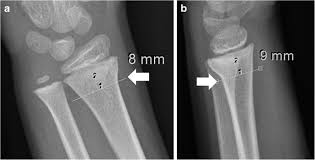 There is no deformity in the wrist, which means the wrist will not be out of its usual shape. Differentiating Stable Buckle Fractures From Other Distal Radius Fractures The 1 Cm Rule Springerlink