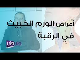 أعراض الورم الخبيث في الرقبة Youtube