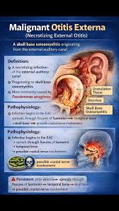 Image result for Necrotizing Otitis Externa
