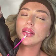 Obsessed with these lips! , We are LOVING Russian Cannula in clinic for  that carved out signature Russian look, without the bruising or swelling ❌  , Free consultations, send a message or call 01254 ...