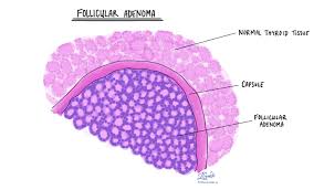 Thyroid cancer rates seem to be increasing. Follicular Carcinoma Of The Thyroid Gland Mypathologyreport Ca