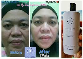 Adsbygoogle Window Adsbygoogle Push Diskon Obat Menghilangkan Noda Hitam Gigitan Nyamuk Trulum Di Wilayah Sema Perawatan Wajah Obat Jerawat Serum