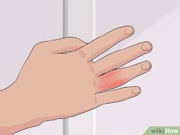 Such ligaments can easily become vulnerable to overstretching and tearing. Easy Ways To Know If You Sprained Your Finger 10 Steps