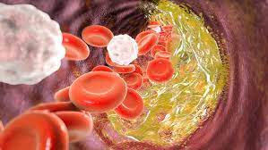 Cholesterin Senken Wenn Jungere Menschen Hohe Cholesterinwerte Haben