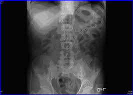 Image result for Neutropenic Colitis