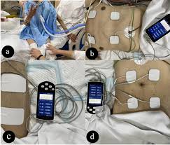 Image result for Electrical Stimulation Therapy