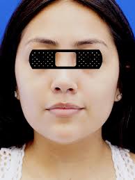 Buccal Fat Removal 3053