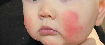 Image result for red rash face